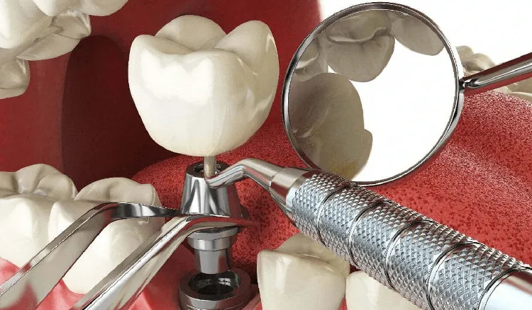 Free dental implants: everything you need to know