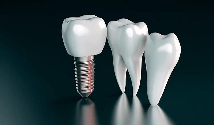 How to Get Free Dental Implants in the United States
