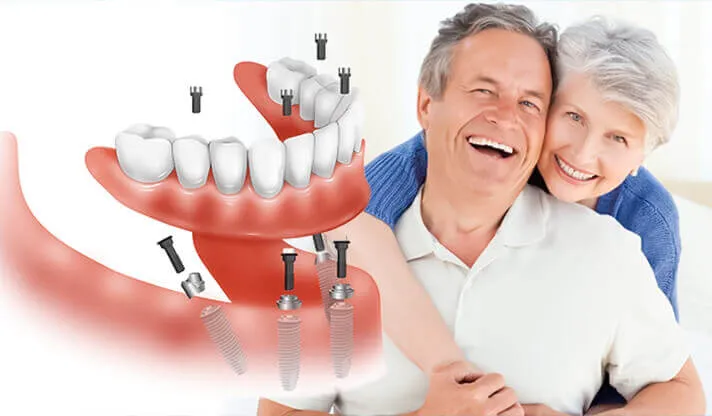 The Benefits of Dental Implants for Seniors