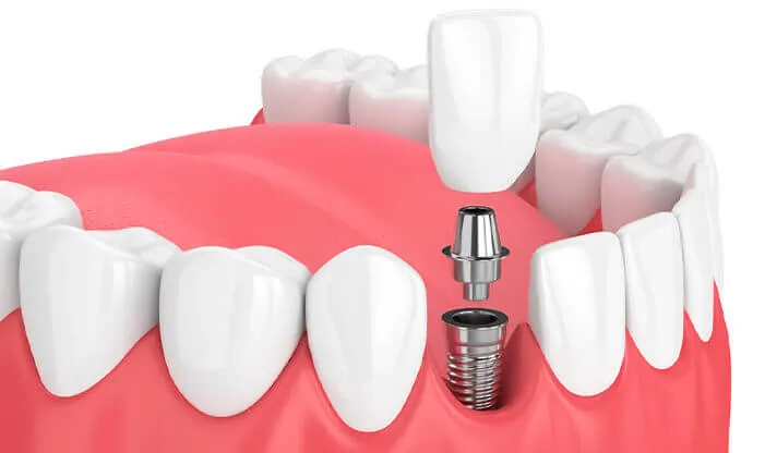 The Cost of Dental Implants for Seniors